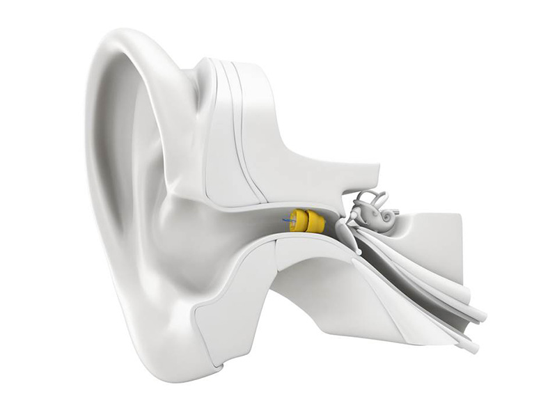 Discreet in-ear hearing device